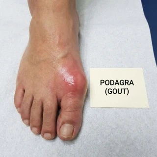 Inflamed and swollen big toe during a gout flare