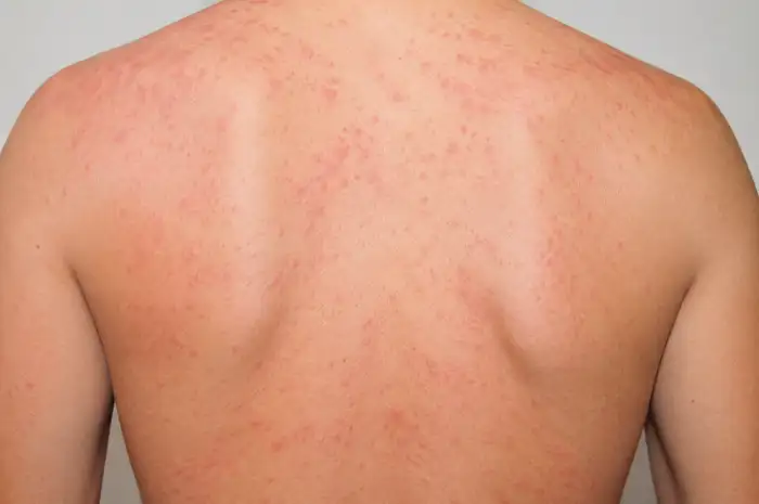 What is Adult Onset Still's Disease?