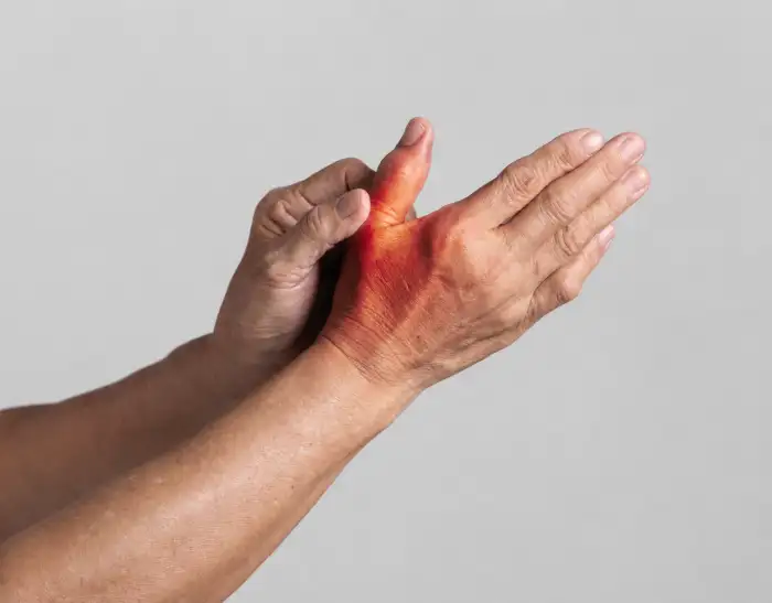What is Post-Infective Arthritis