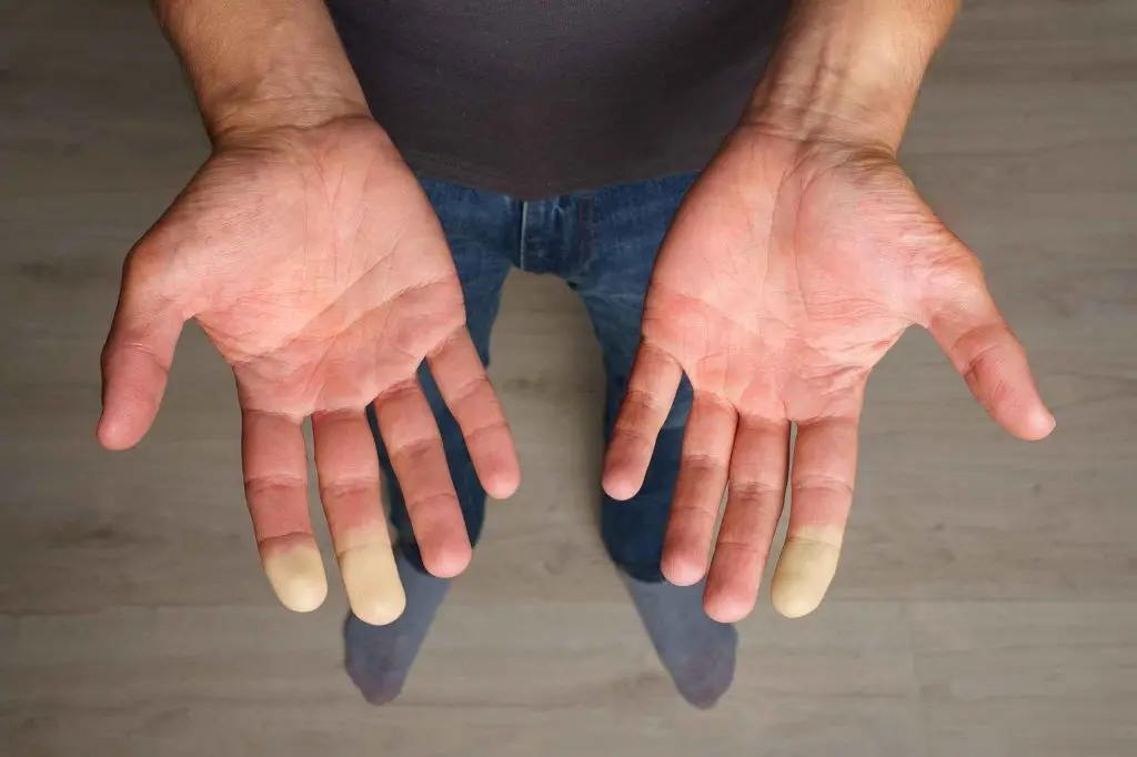 Autoimmune Flares in Winter: Why Lupus & Raynaud’s Worsen in the Cold
