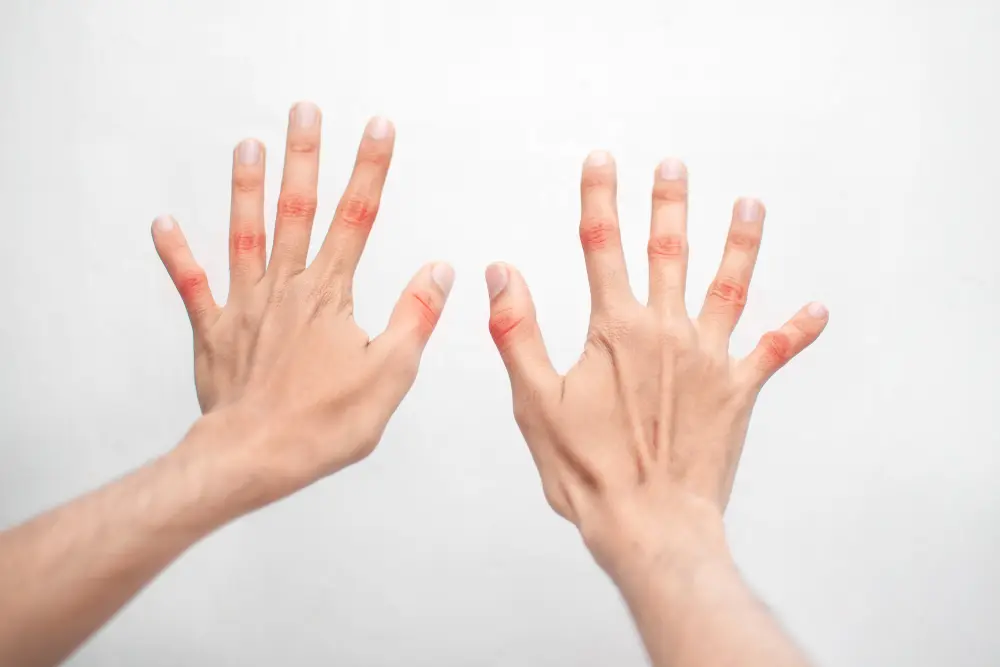 Hands of man experiencing rheumatoid arthritis.