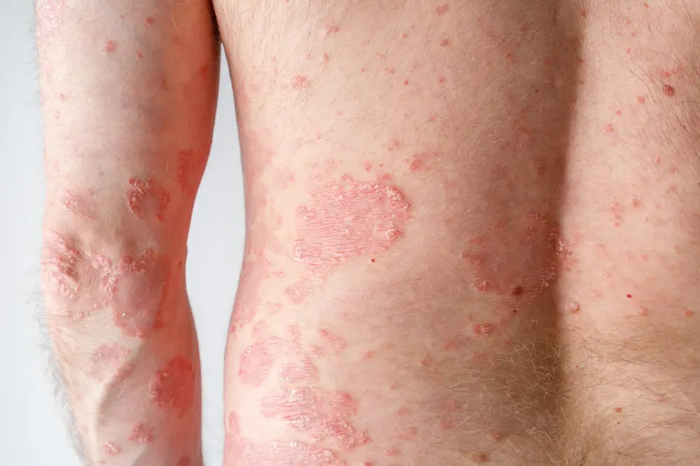Man suffering from psoriasis
