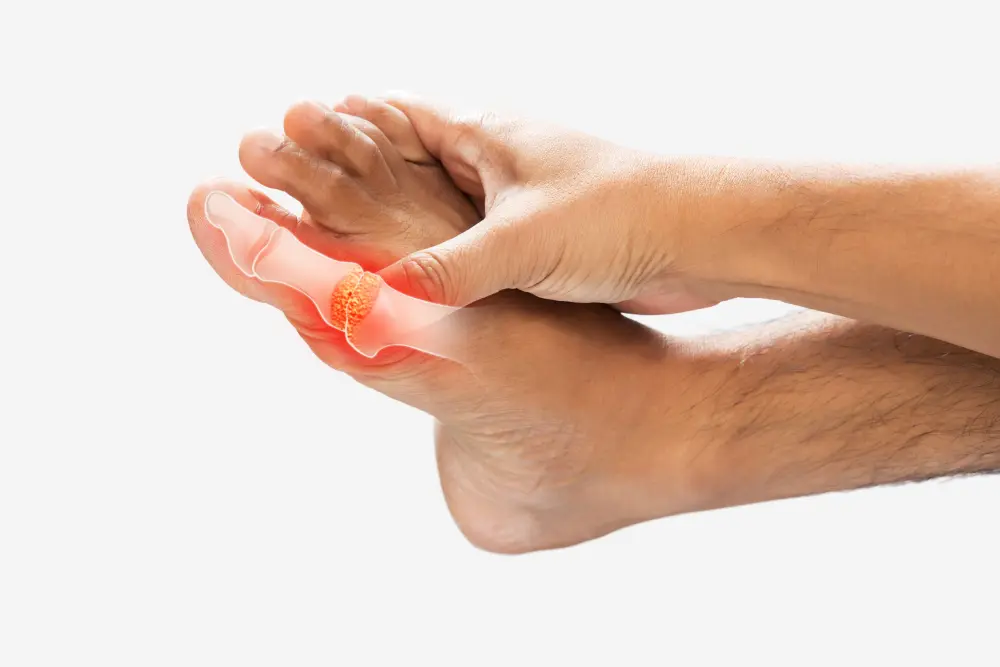Man toe bones containing high levels of uric acid