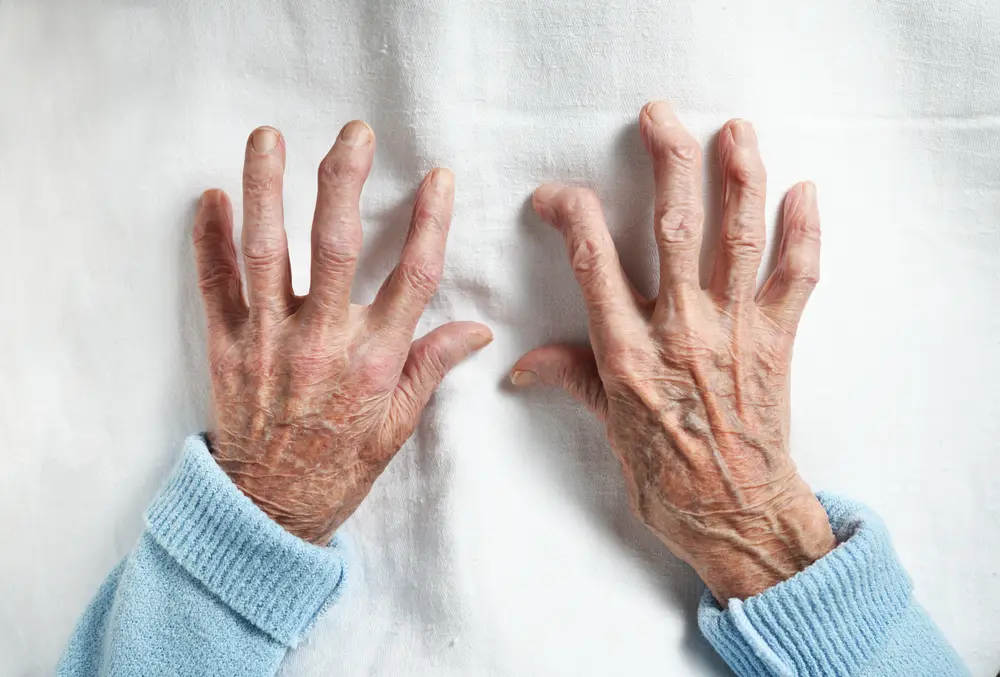Osteoarthritis and rheumatoid arthritis in hands