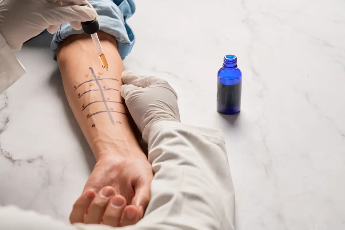 What are Allergy Skin Tests?