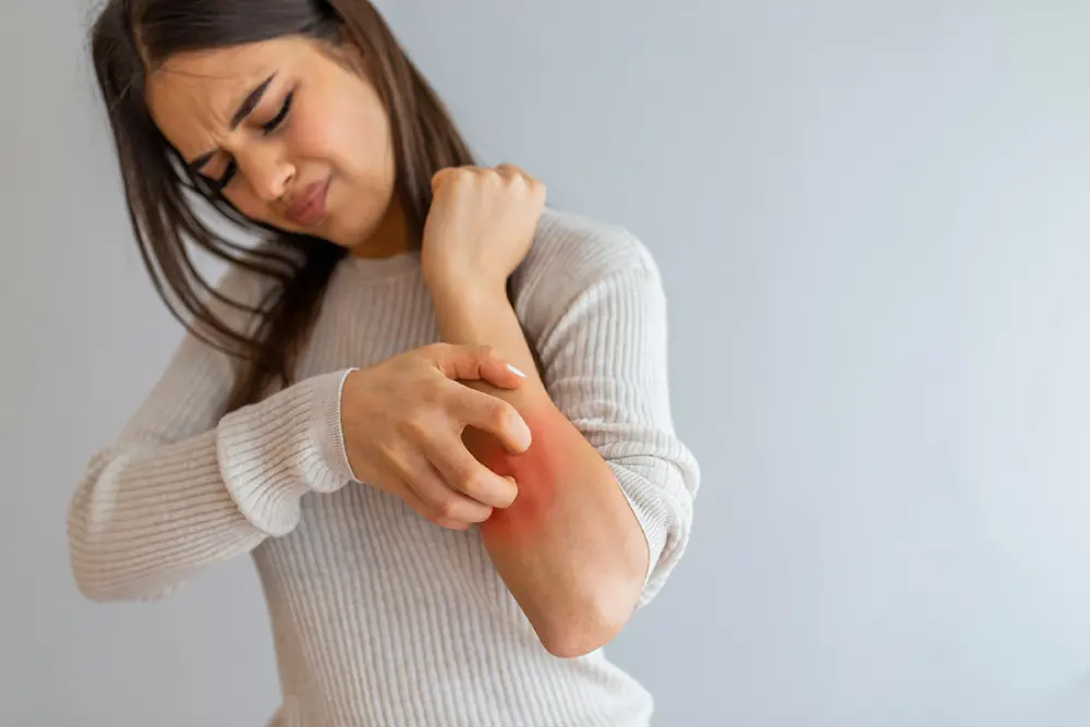 A woman suffering from skin rashes