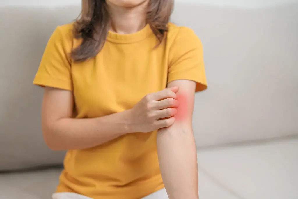 A woman scratching her lupus flare